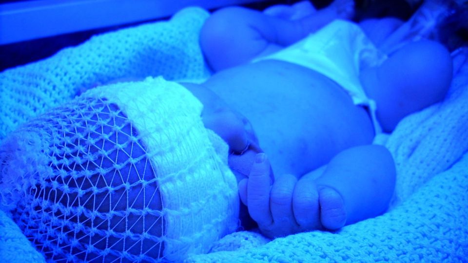 Neonatal Sarılık görseli - DrCem hastalık rehberi
